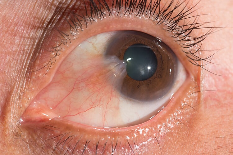 ภาพแสดงต้อเนื้อ (Pterygium) ในดวงตา ตัวอย่างปัญหาที่รักษาด้วยการผ่าตัดแบบปลูกถ่ายเนื้อเยื่อเยื่อบุตา (Conjunctival Graft)