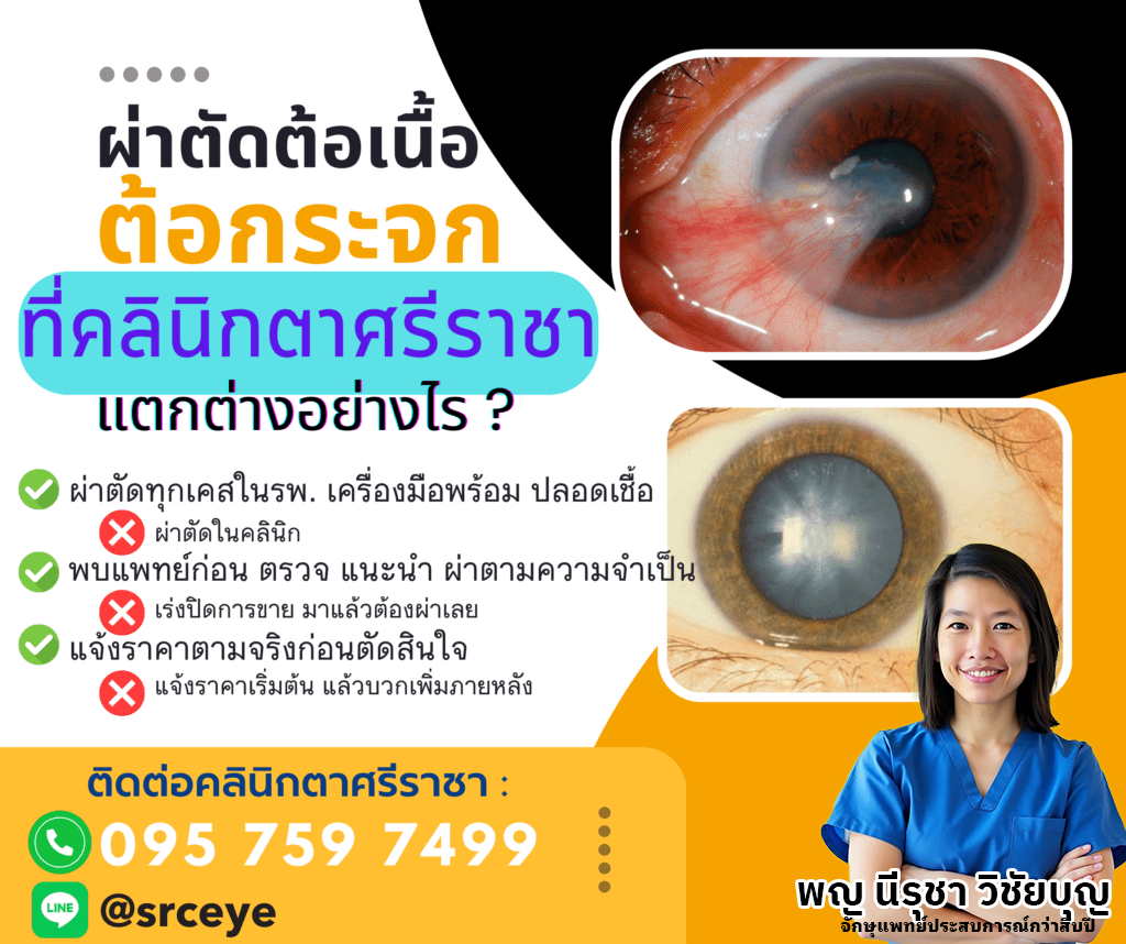 ผ่าตัดต้อเนื้อ ผ่าตัดต้อกระจก